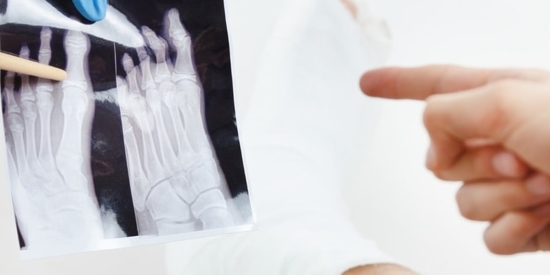 Sprained Big Toe vs. Broken Big Toe: Causes, Symptoms & How to Treat