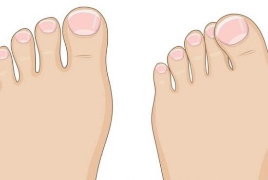  What Are Bunions?