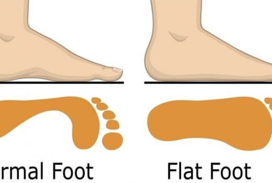  Flat Feet
